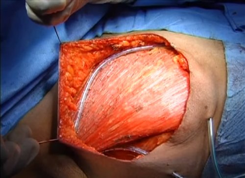 Modified Radical Mastectomy